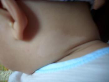 兒童白癜風發病的常見病因有哪幾種