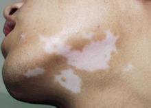 陽光暴曬是誘發白癜風的原因嗎