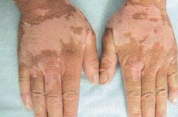 白癜風的發病原因與哪些因素有關?