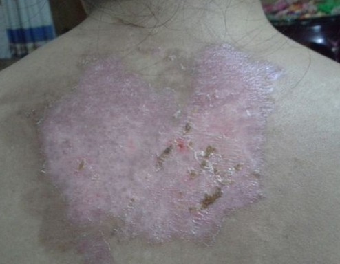 背部長白癜風(fēng)可能是什么因素引起的?