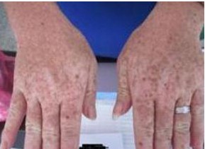 導(dǎo)致雙手白癜風(fēng)的原因