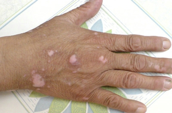 引發白癜風的病因是什么呢