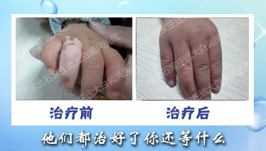 手腳為什么會長出白癜風呢