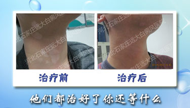 男性長白癜風一般是因為什么