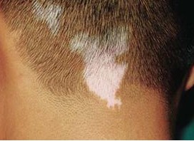 頭上長白癜風是怎么回事