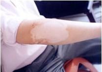 胳膊上白斑會不會是白癜風?