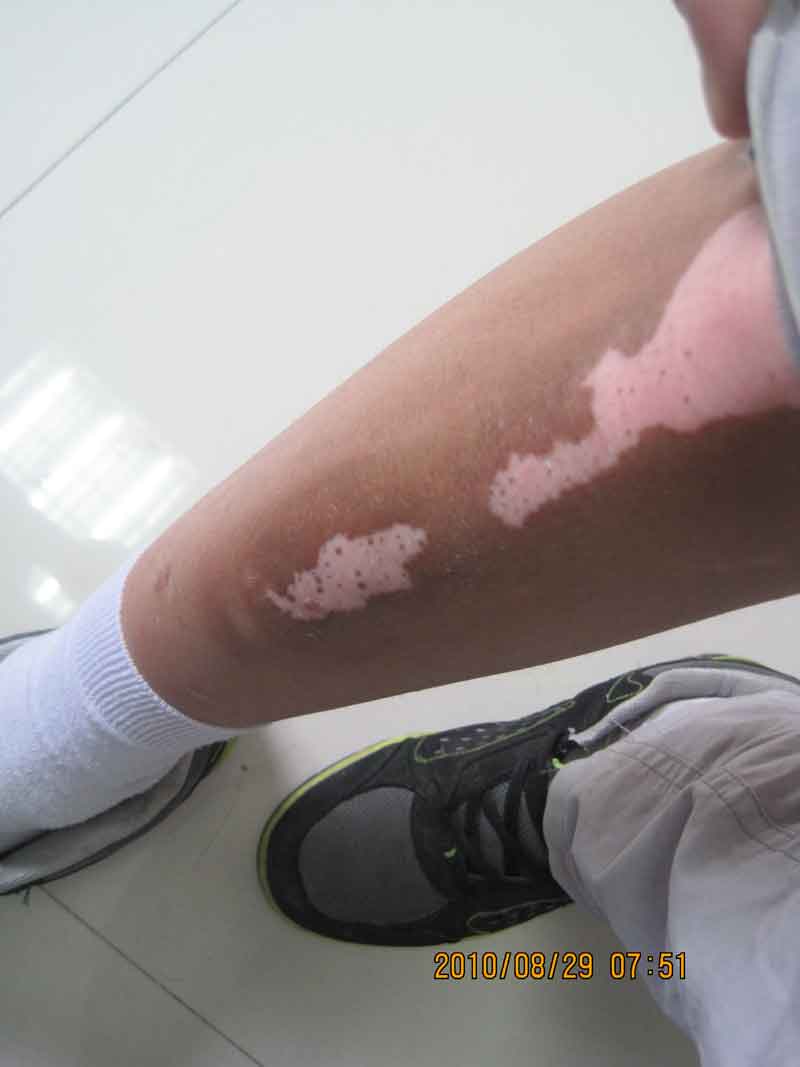 腿部白癜風的癥狀有哪些