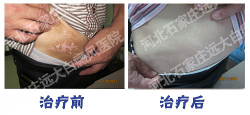 腰部出現(xiàn)白癜風(fēng)怎么治療好