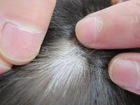 頭上白癜風如何治療好?