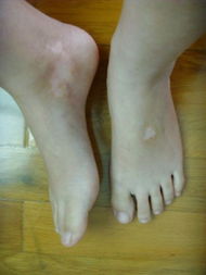 雙腳白癜風(fēng)是怎么回事