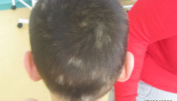 頭部白斑怎么治療好