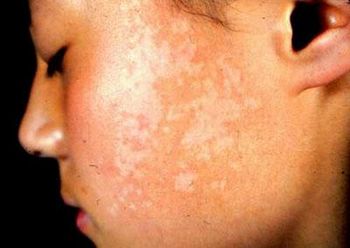 什么方法治療臉上早期白癜風效果顯著