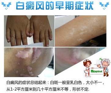 <a href=http://m.xvxgx.cn/zhengzhuang/4732.html target=_blank class=infotextkey>白癜風(fēng)早期癥狀</a>圖