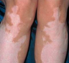  腿上發展期白癜風有沒有治療的好方法