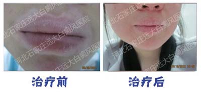  臉上小片白癜風能吃藥治療嗎