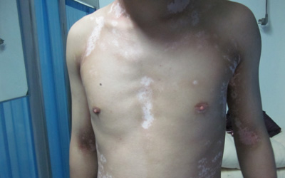  暈痣型白癜風在胸部怎么辦