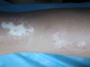 手臂白癜風(fēng)怎么治好得快