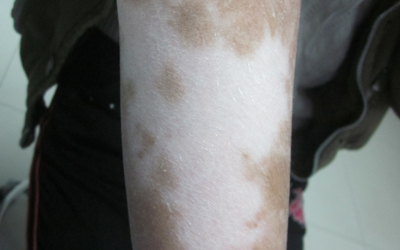 手臂穩定期白癜風怎么治有效果