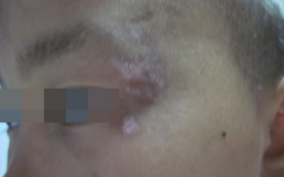 臉上有白癜風怎么治療好的快點