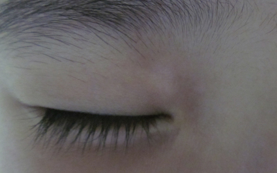 下眼皮睫毛根部白癜風