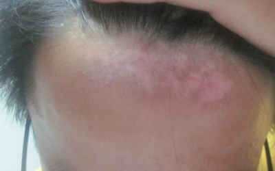 額頭白癜風補骨脂治療行嗎