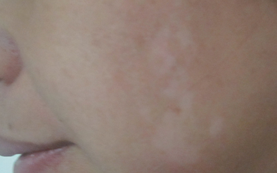 臉蛋上有指甲蓋那么大白斑是什么病