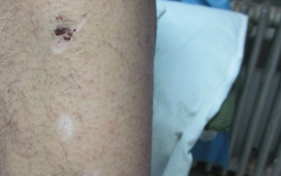 疙瘩擠破后結(jié)痂成了白斑