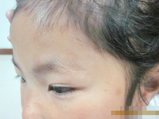 8歲兒童多處散發(fā)型白癜風(fēng)治好