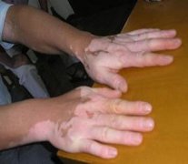 滄州哪家白癜風醫院308激光治療比較便宜