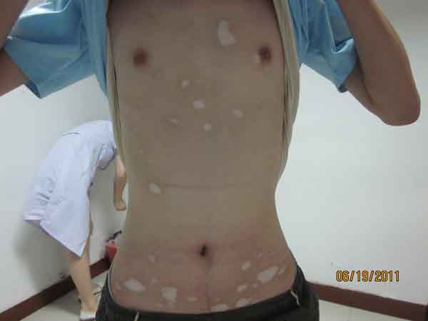 白癜風會反復發作嗎