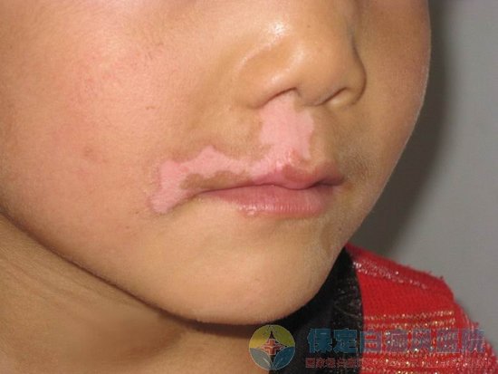 石家莊白癜風醫院:有效治療白癜風的土方法