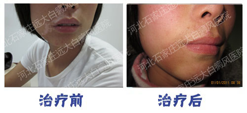 <a href=http://m.xvxgx.cn/ target=_blank class=infotextkey>石家莊白癜風醫院</a>白癜風初期用藥能治好么