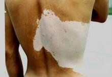 <a href=http://m.xvxgx.cn/ target=_blank class=infotextkey>石家莊白癜風醫院</a>防止白癜風擴散的方法