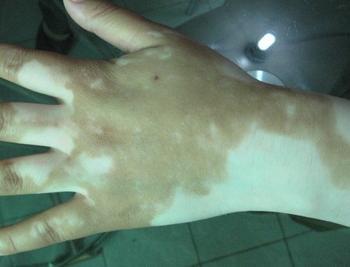 患有白癜風(fēng)反復(fù)發(fā)作的原因是什么?