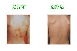 白癜風植皮后留下的黑色素怎么去掉?