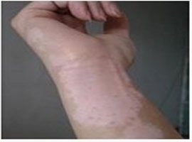 醫生是通過哪些癥狀表現確定皮膚白斑是不是白癜風的?