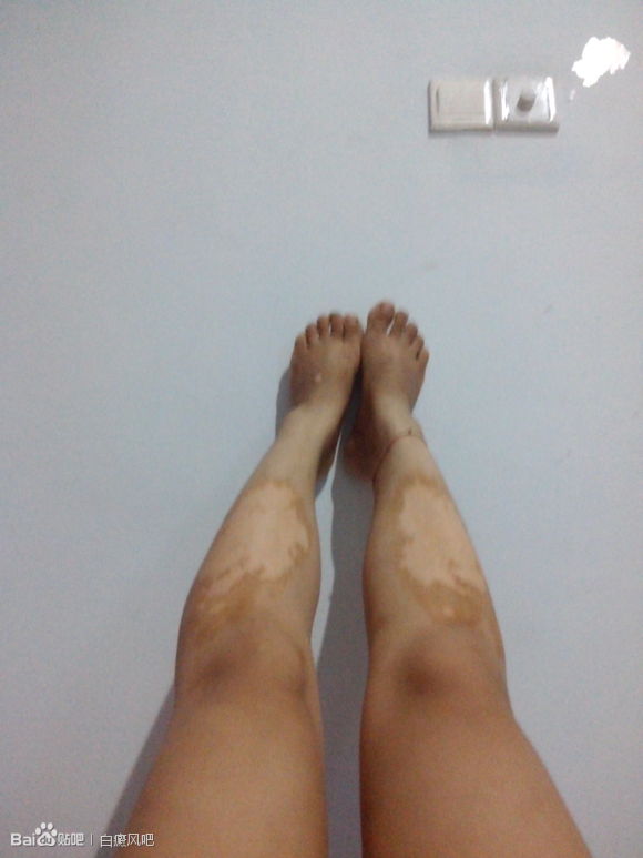 肢端型白癜風有哪些是需要注意的?