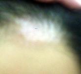 怎樣診斷頭上一片一片的白點是不是白癜風?