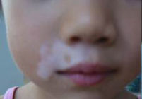 嘴唇上下長小塊白癜風(fēng)該如何控制?