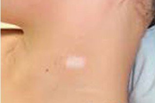 身上的白點一定是白癜風嗎?