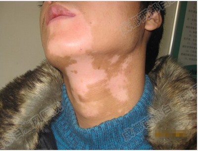 男性吃治白癜風的中藥期間懷孕的小孩子能要嗎?