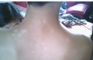 白癜風是家族遺傳性疾病嗎?