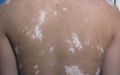 白癜風是不是可以治好？