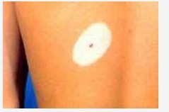 暈痣和白癜風有什么聯系?