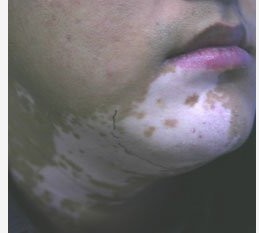 臉上長白斑治療要注意什么