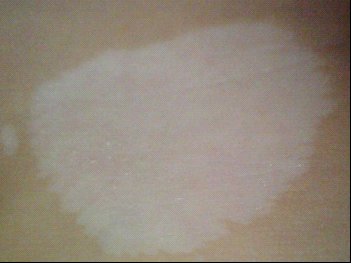 先天性白癜風與后天獲得性白癜風是否都能治好?