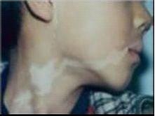 10歲男孩臉上的白色小包包是什么?