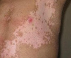 白斑擴散是否白癜風病情惡化了