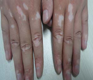 治療手部白癜風有哪些注意事項