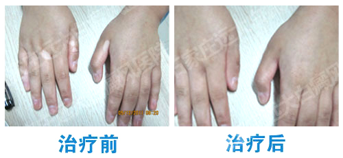 手上長了許多小白點(diǎn)是白癜風(fēng)嗎